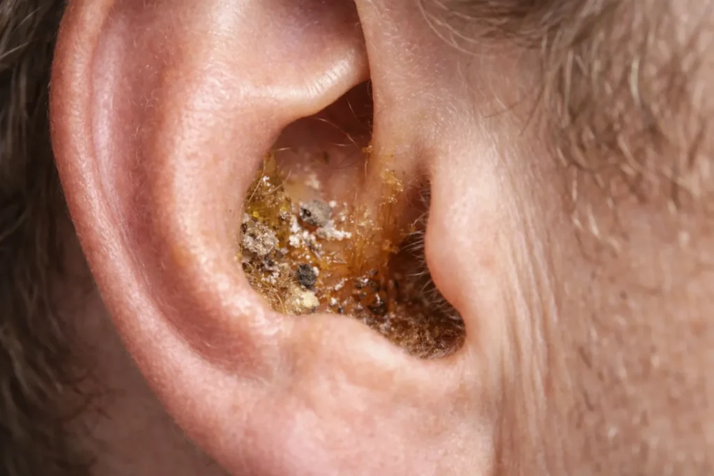 What Is EarWax
